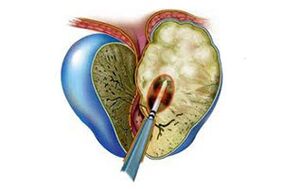 Manifestazione di prostatite acuta