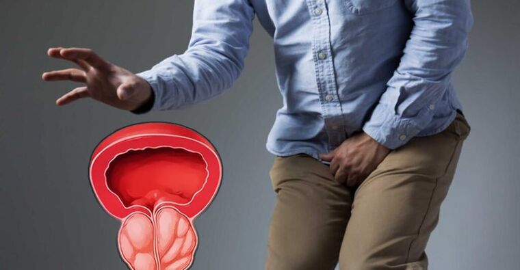 Prevenzione della prostatite e prostata -adenoma